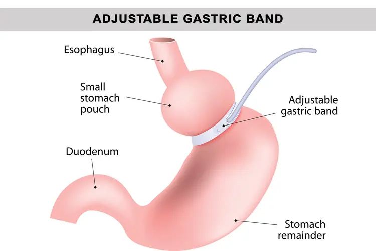 Common Types of Weight Loss Surgery