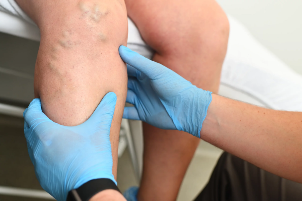 The Link Between Obesity and Varicose Veins: What to Know