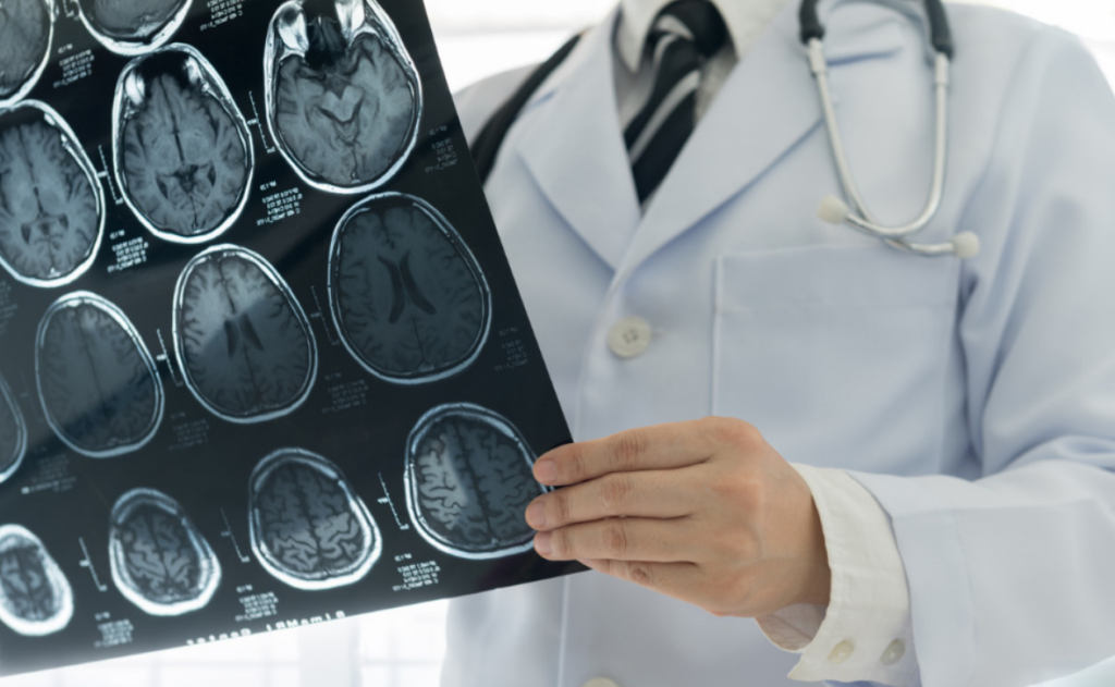How Neurology Specialists Diagnose and Manage Migraines