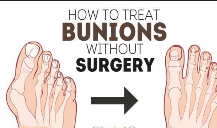 The Impact of Bunions on Daily Life and Footwear Choices